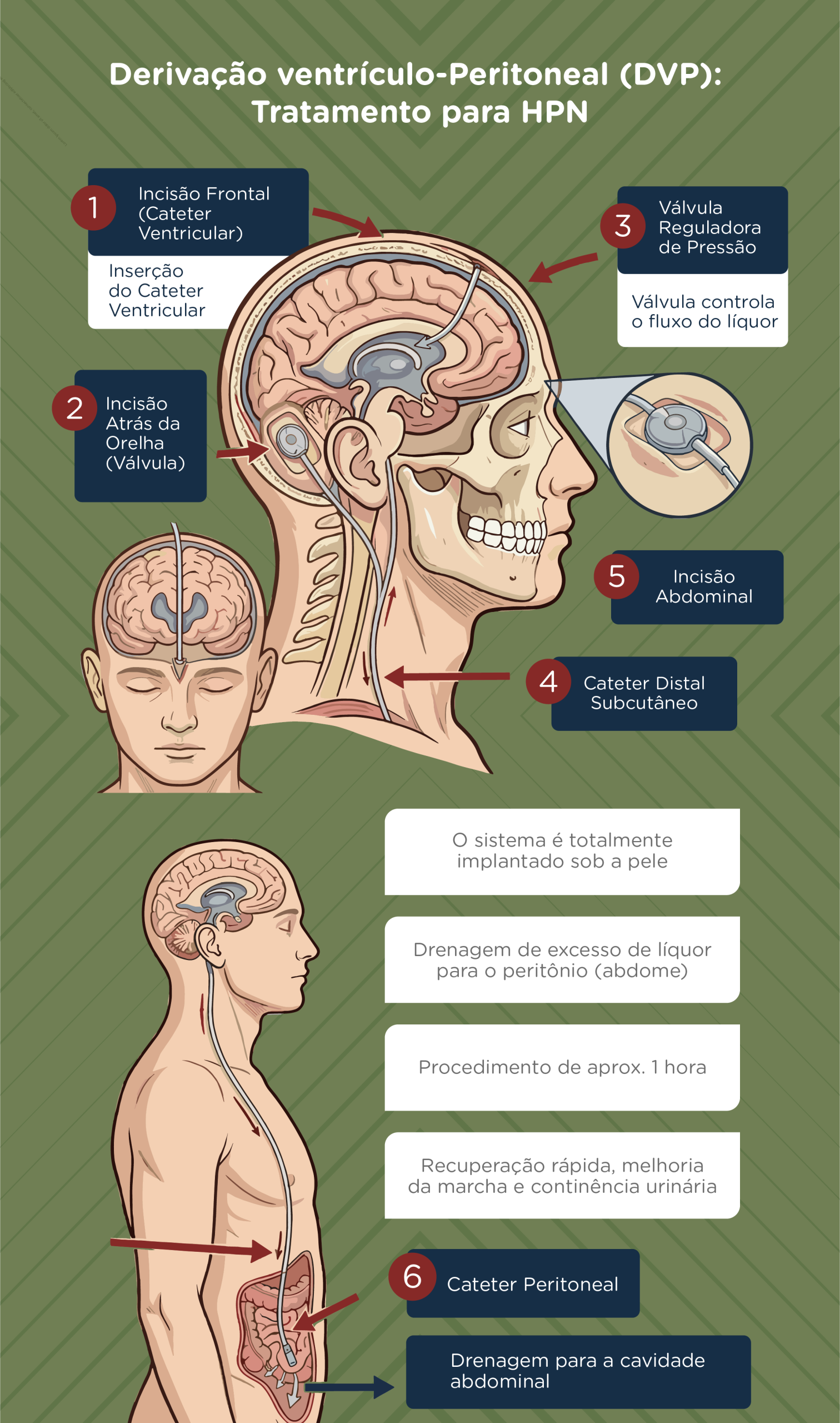 Derivacao-ventriculo-peritoneal-DVP-tratamento-para-HPN